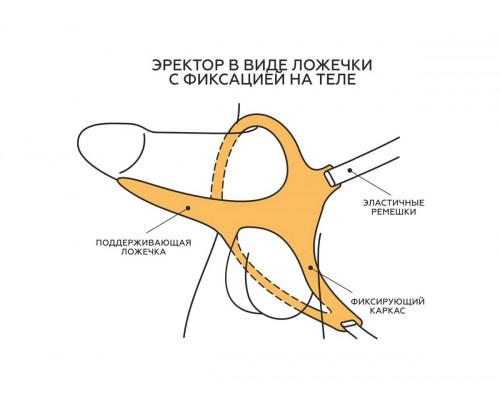 Заказать Эректор с фиксацией